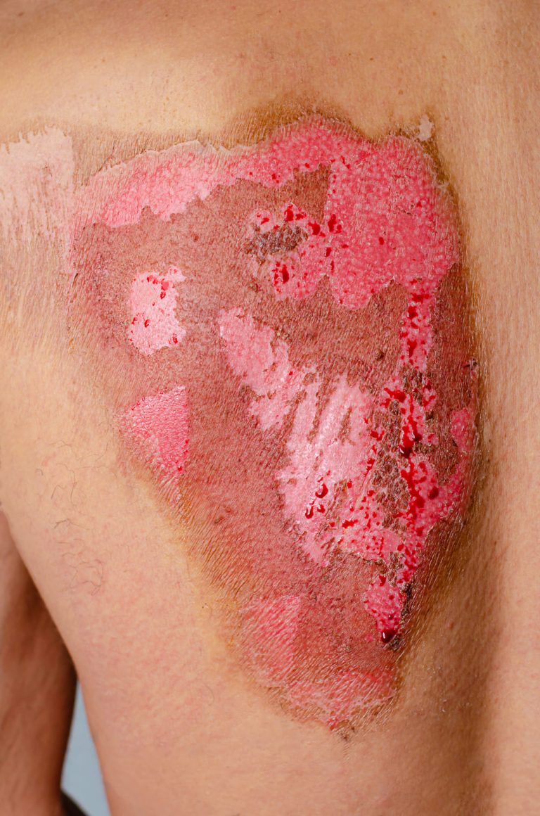 Burn Reconstruction Surgery - Dr. Ernst Möller